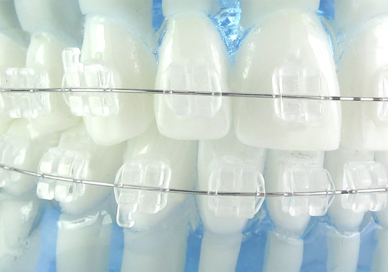 clear aesthetic brackets
