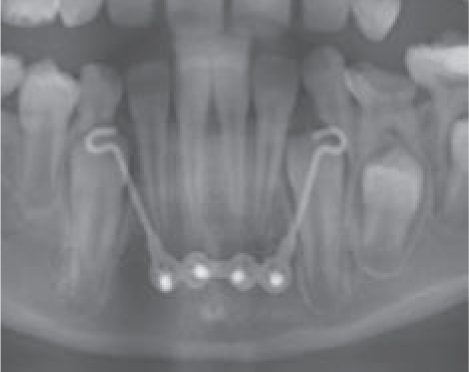 MENTOPLATE System 3