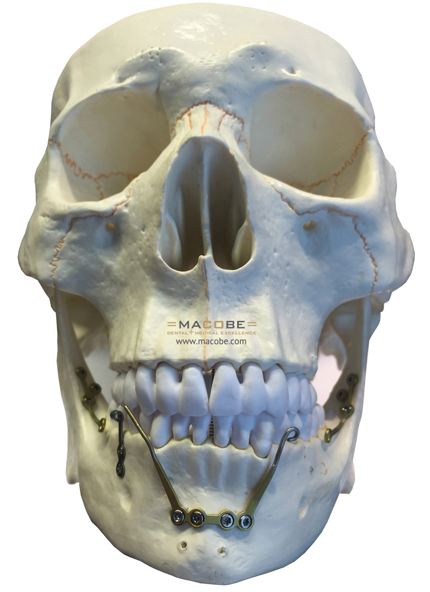 Skull Mentoplate Alveolarplate