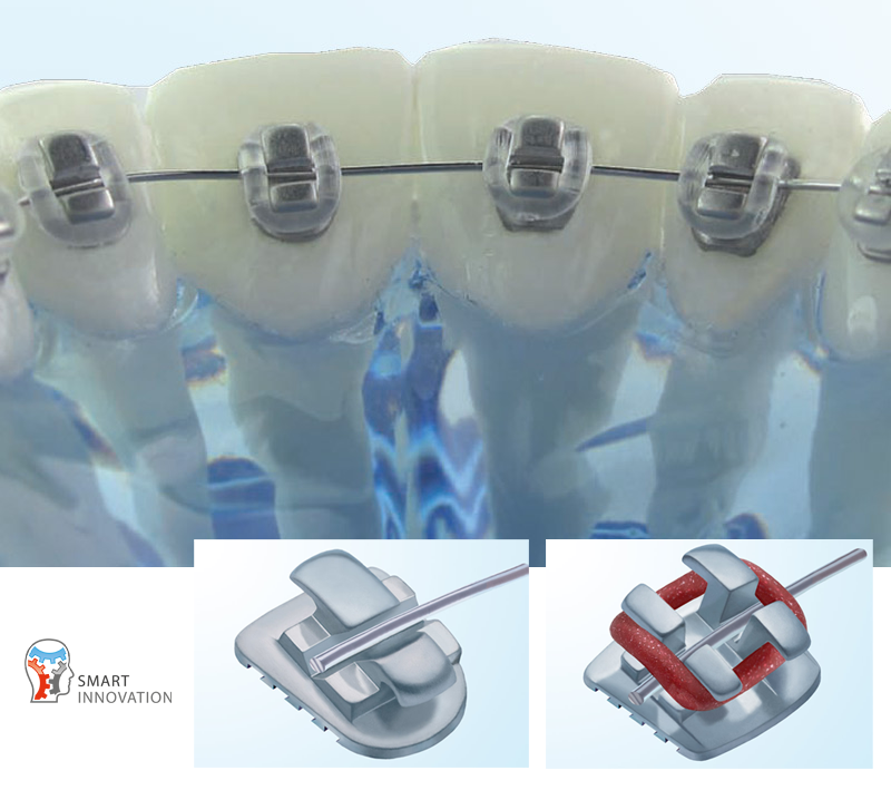 joy brackets